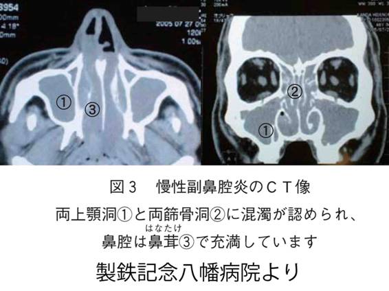 蓄膿症 歌